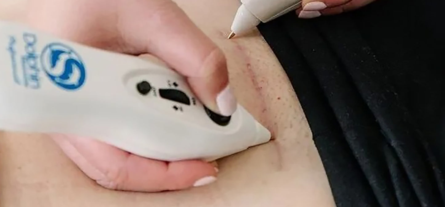 hands performing Microcurrent Point Stimulation using Dolphin device on scarred area on tummy